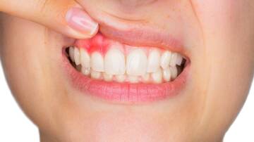 Inflamed gums are a symptom of gum disease. Picture Shutterstock